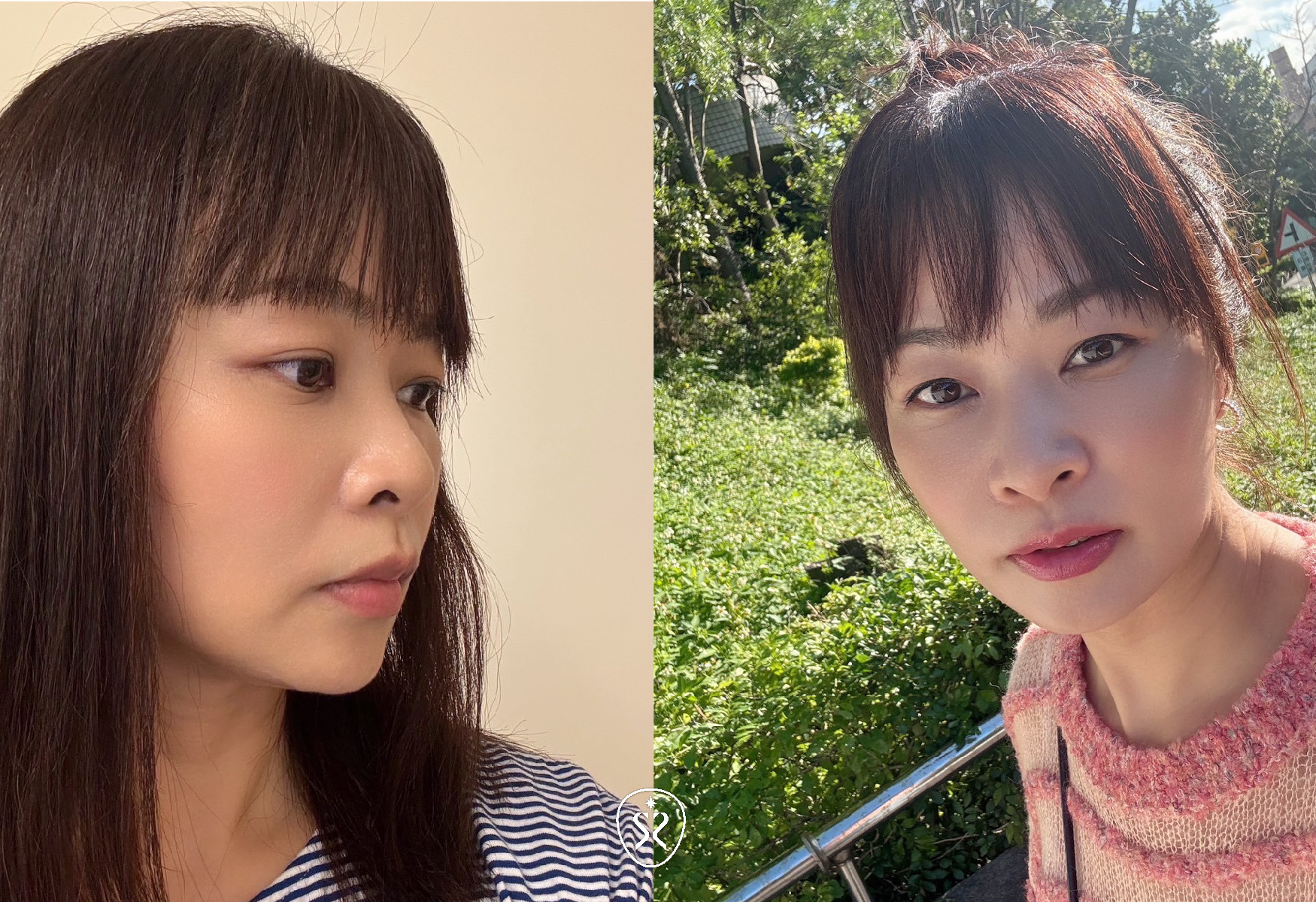 玻尿酸療程施作完後，整個精氣神都明顯變好了